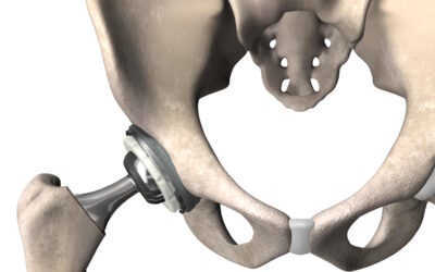 The Current Role Of Robotics In Total Hip Arthroplasty