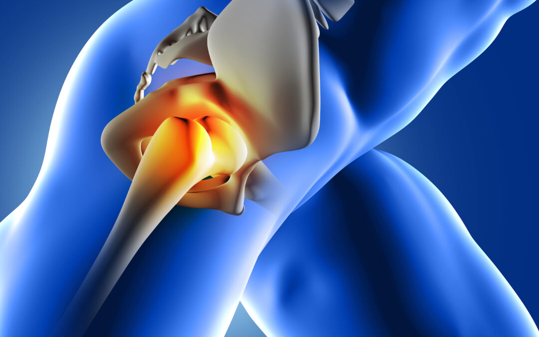Minimally Invasive Hip Replacement: Smaller Incisions, Faster Recovery, and Quicker Return to Normalcy