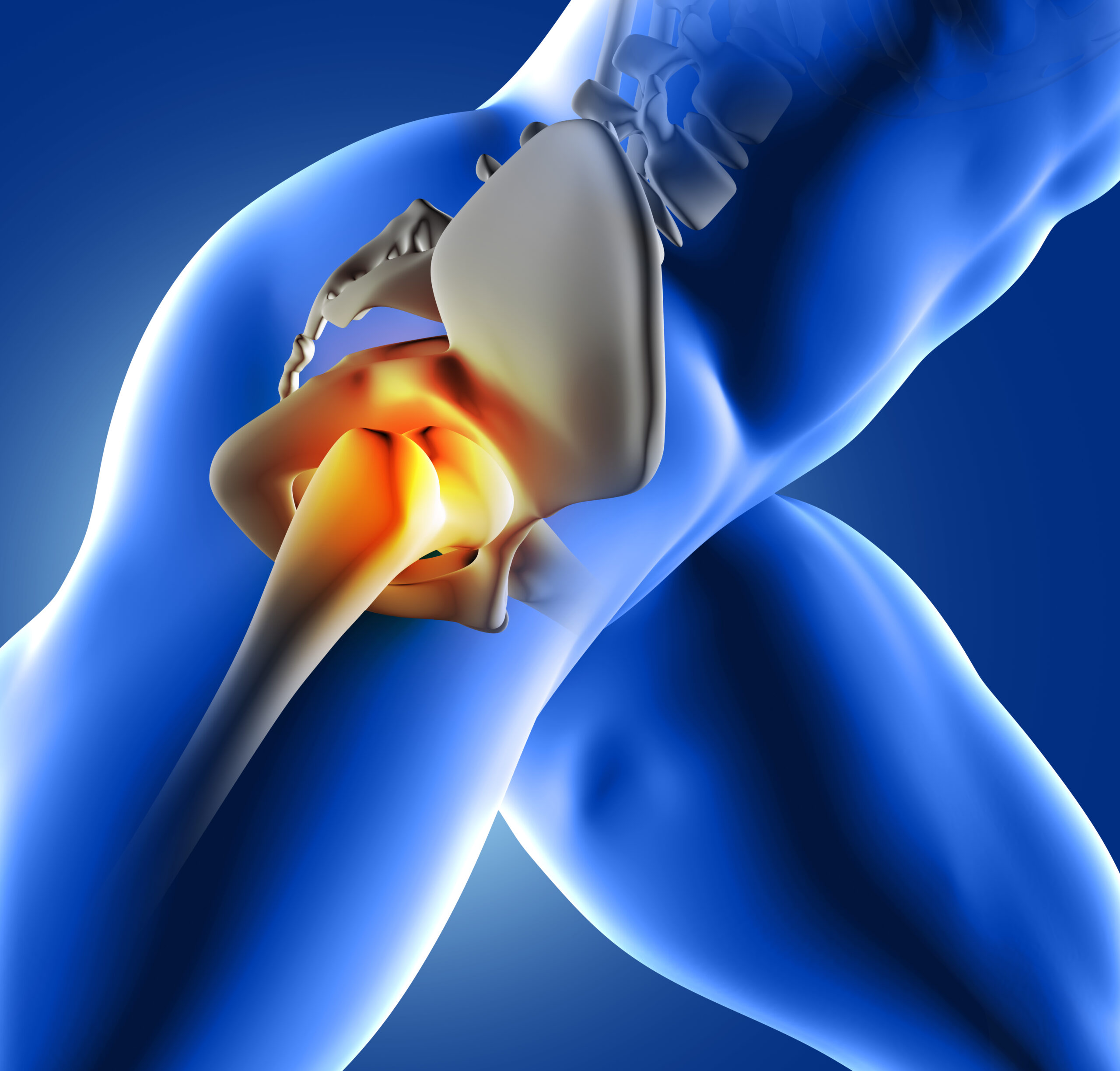 Minimally Invasive Hip Replacement: Smaller Incisions, Faster Recovery, and Quicker Return to Normalcy