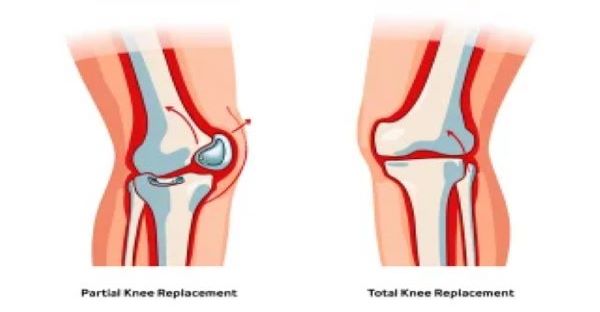 Partial vs. Total Knee Replacement: Which Option Is Right for You?
