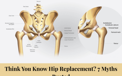 Think You Know Hip Replacement? 7 Myths Busted