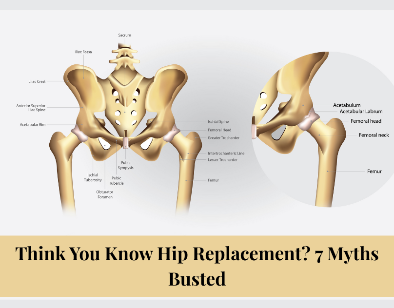 Think You Know Hip Replacement? 7 Myths Busted